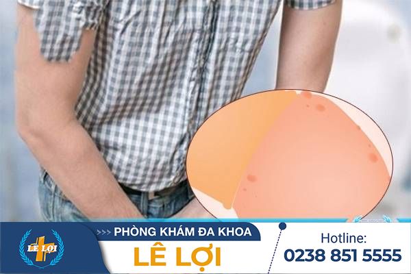 Hình ảnh biểu hiện viêm bao quy đầu do nấm candida